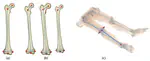 A System for Unsupervised Extraction of Orthopaedic Parameters From CT Data