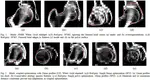 An Articulated Statistical Shape Model for Accurate Hip Joint Segmentation