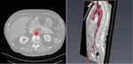 Deep Learning and Image Pyramids for Aorta Segmentation
