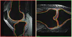 Model Based Auto Segmentation of Knee Bones and Cartilage in MRI Data