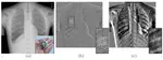Temporal Subtraction of Chest Radiographs Compensating Pose Differences