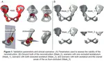 Validation of a Statistical Shape Model for Acetabular Bone Defect Analysis