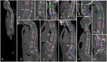 VerSe: a Vertebrae Labelling and Segmentation Benchmark for Multi-Detector CT Images